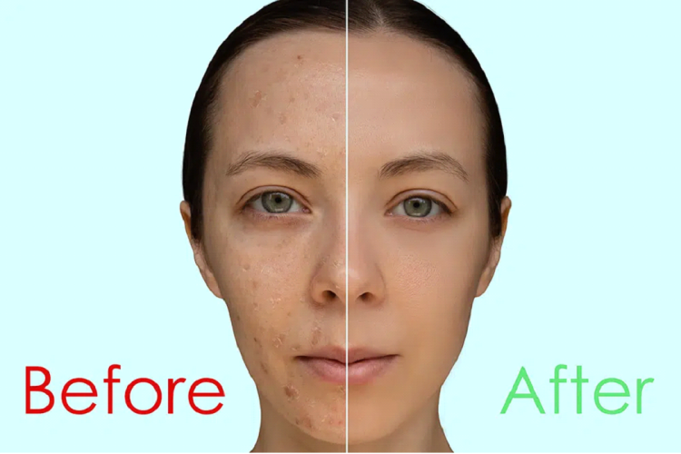 chemical-peel-before-after